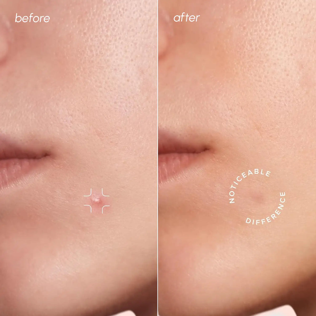 Invisible Pimple & Acne Patches by Maree