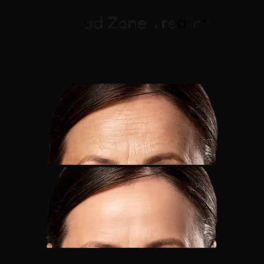 Anti-Wrinkle Forehead Patches by Maree