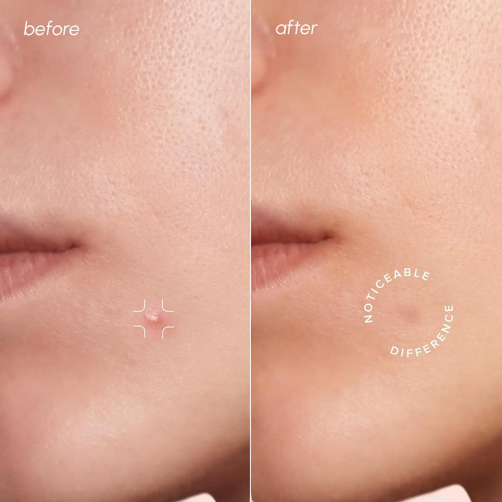 Invisible Pimple & Acne Patches by Maree