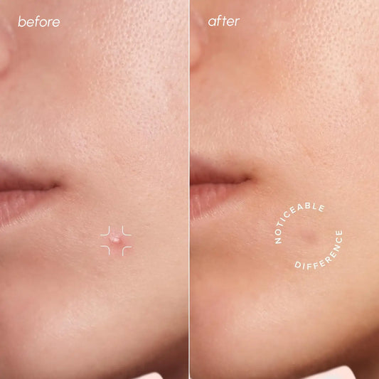 Invisible Pimple & Acne Patches by Maree