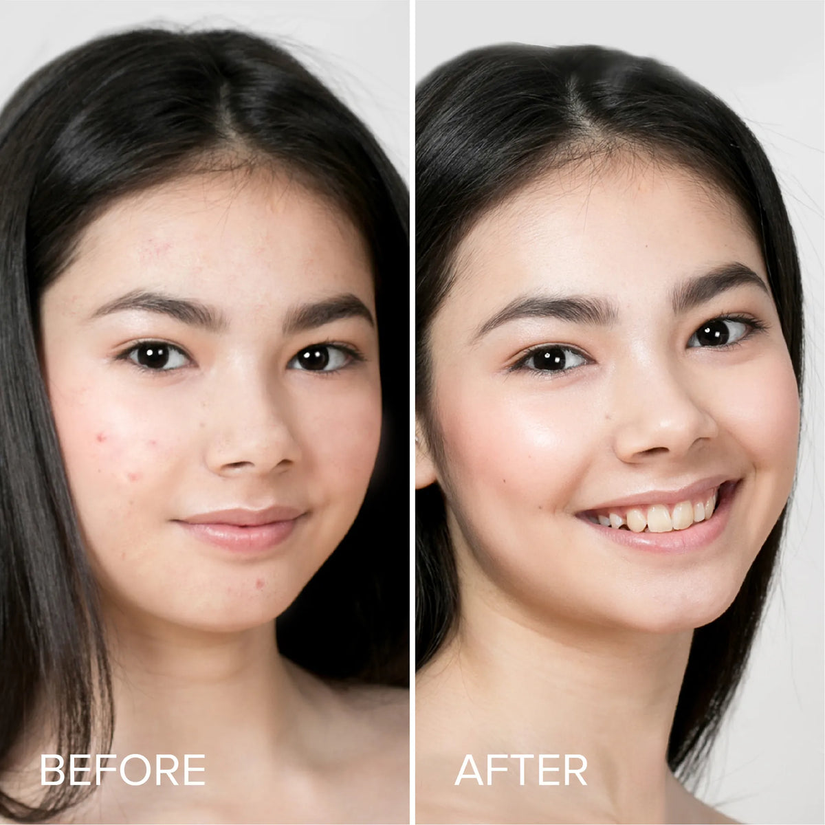 Pimple & Acne Patches by Maree