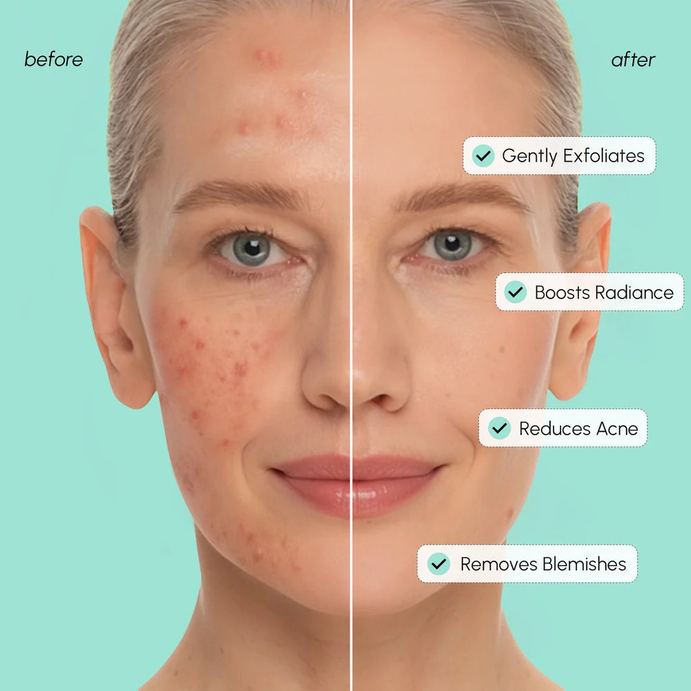 Azelaic Acid Soothing Pads by Maree