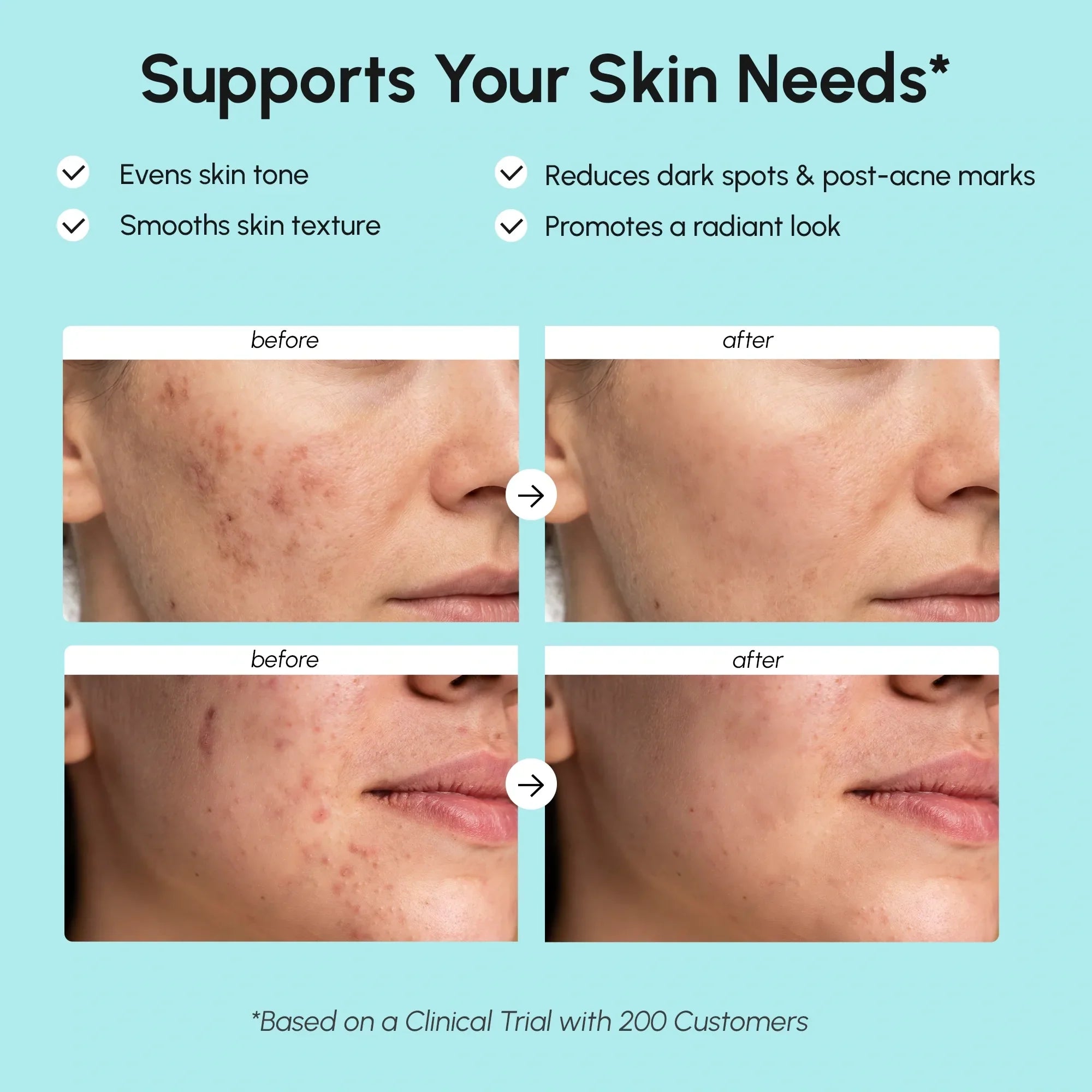 Azelaic Acid Cream for Sensitive Skin by Maree