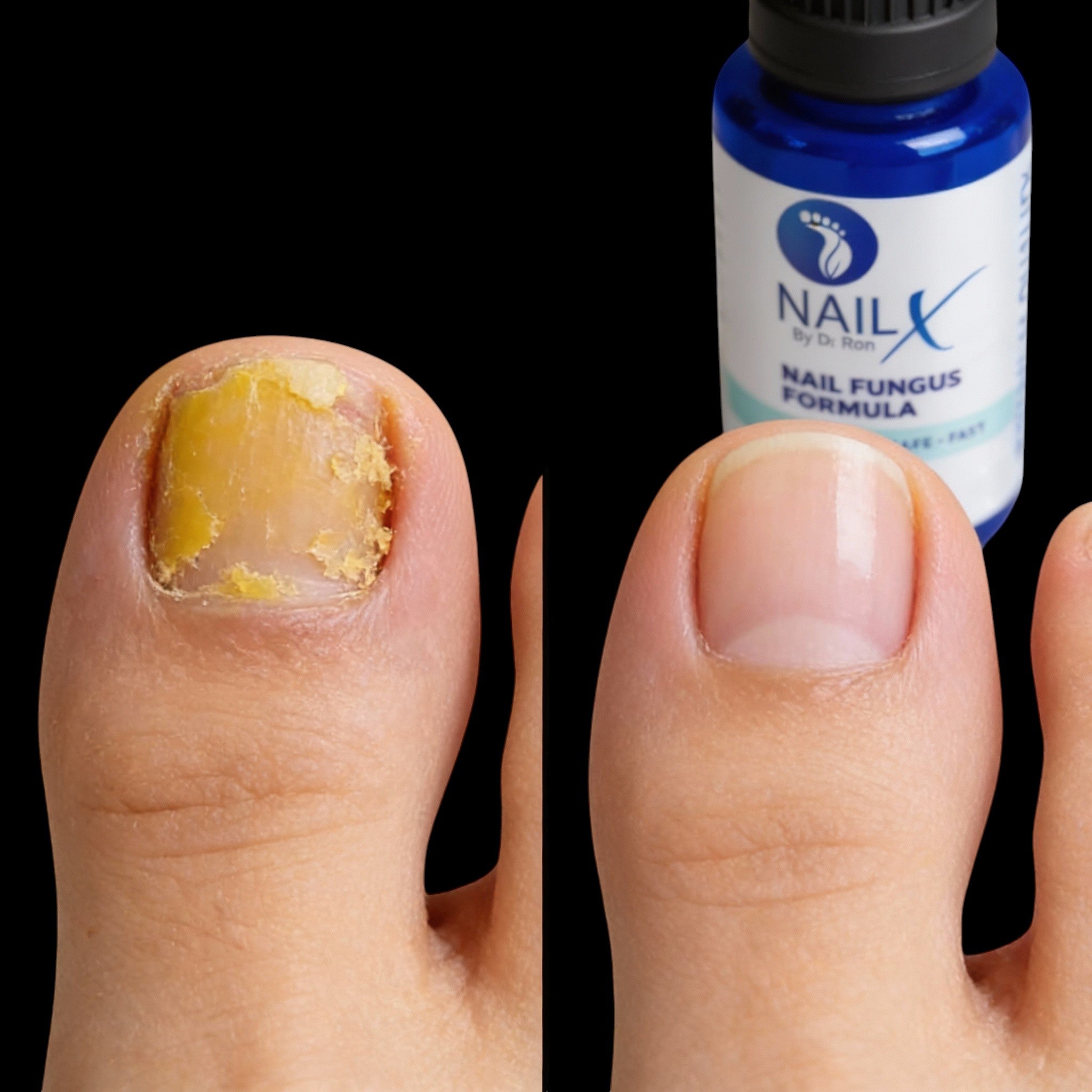 NailX Topical Nail Solution – Repair for Discolored, Damaged & Fungal-Prone Nails by Foot Butter by Dr Ron