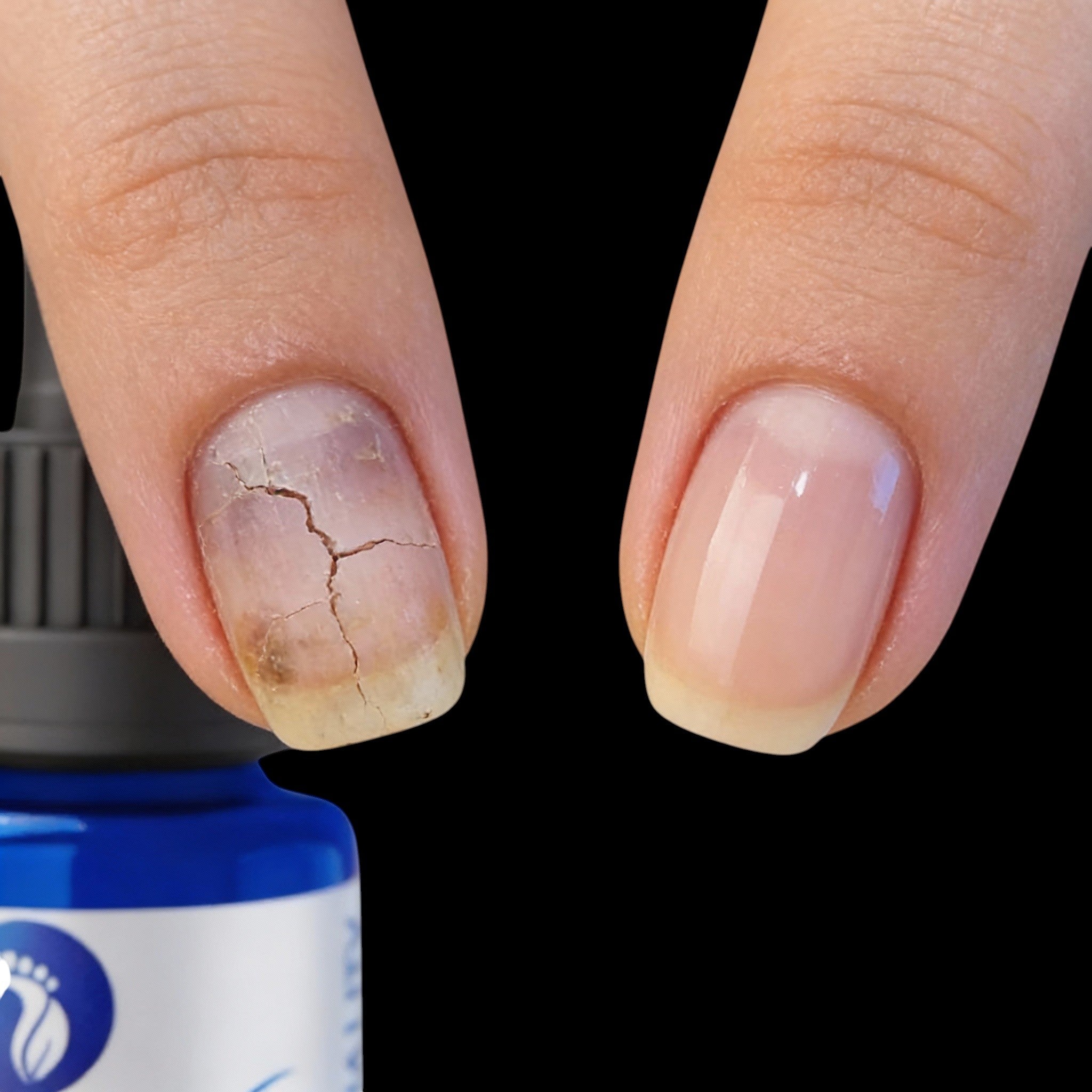 NailX Topical Nail Solution – Repair for Discolored, Damaged & Fungal-Prone Nails by Foot Butter by Dr Ron